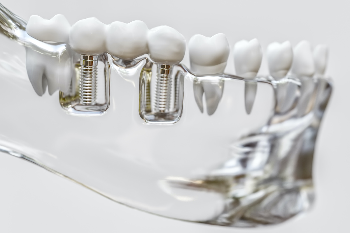 implantes dentales granada