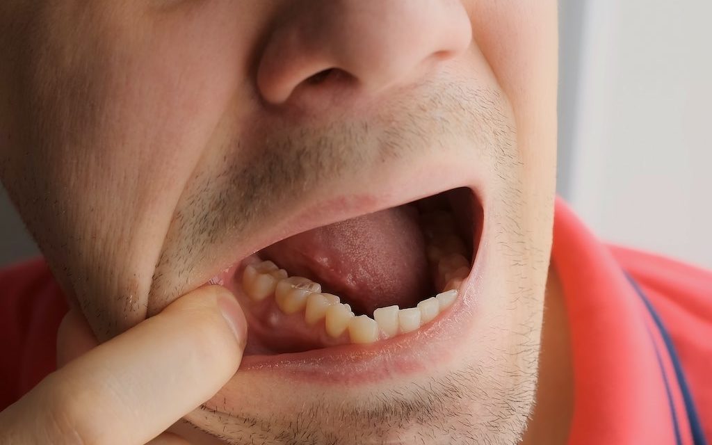 Causas y tratamientos de los abscesos dentales