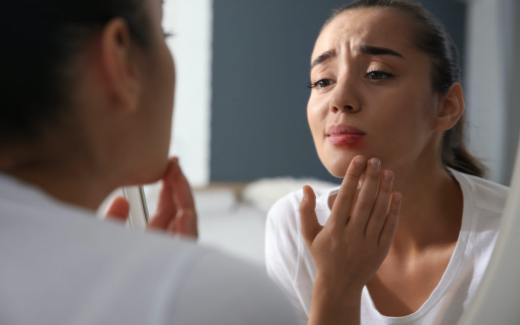 Herpes labial: ¿Qué es y por qué sale?