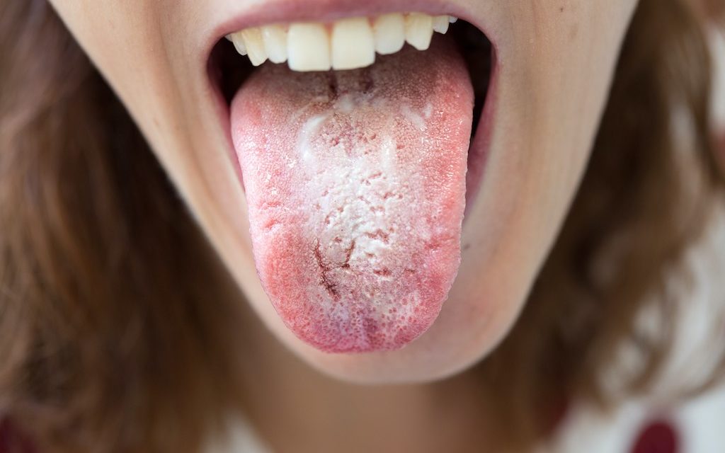 Principales causas de la lengua blanca