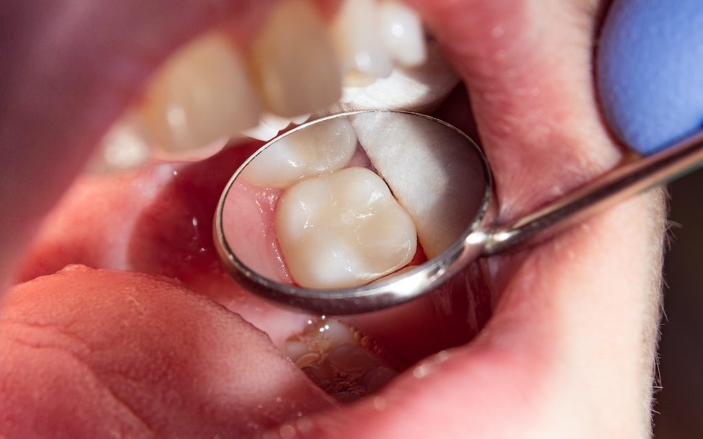Qué son y función de los dientes molares