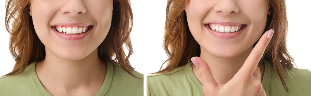 gingivitis antes y despues