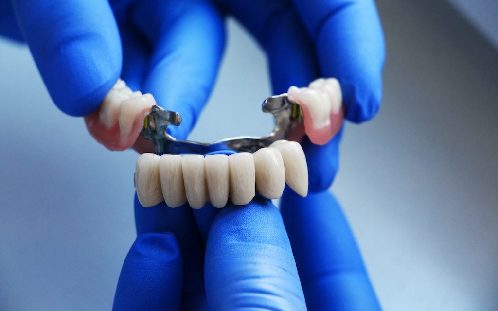 Descubre los puentes dentales