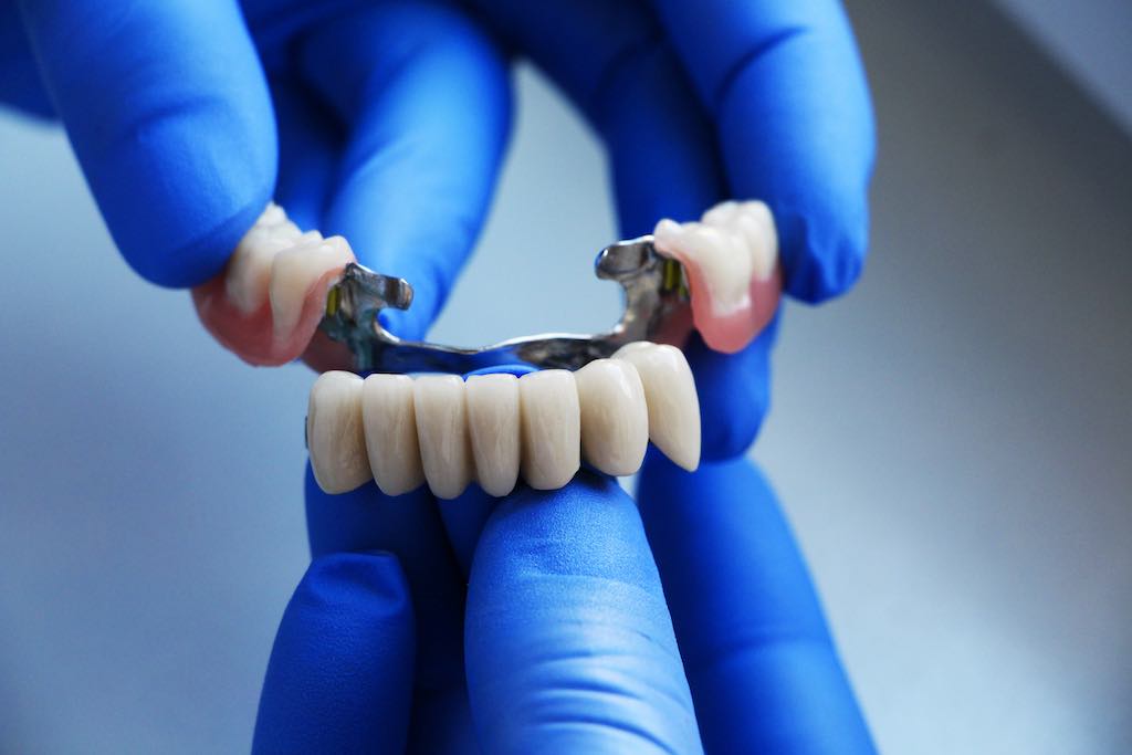 Dental Marfil - 🔹️PUENTES FIJOS DE PORCELANA🔹️ Son los más esteticos  porque se asemejan a sus dientes naturales. Este tipo de puente consiste a  dos coronas que se sostienen de sus dientes