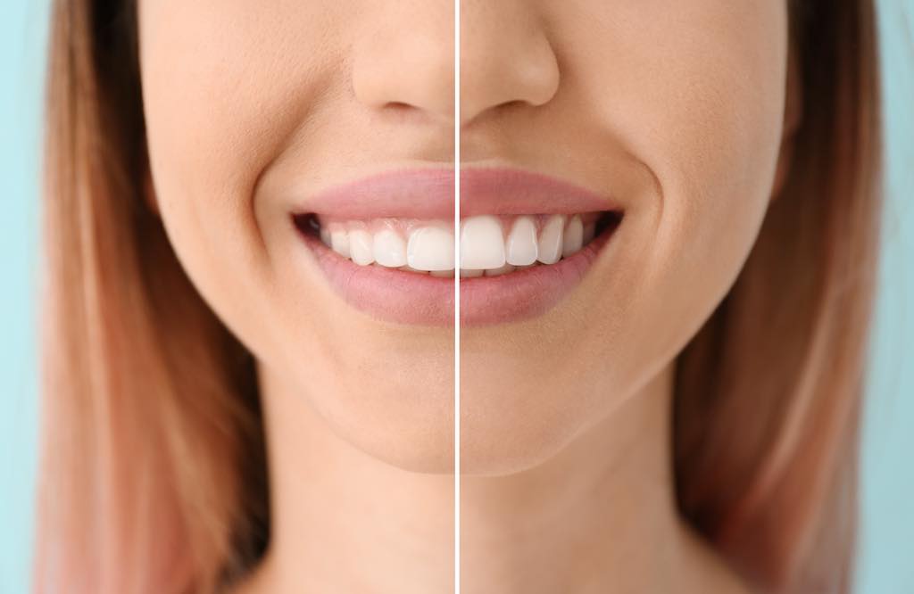 Sonrisa Gingival. Causas Y Tratamientos | Miriam Cantero