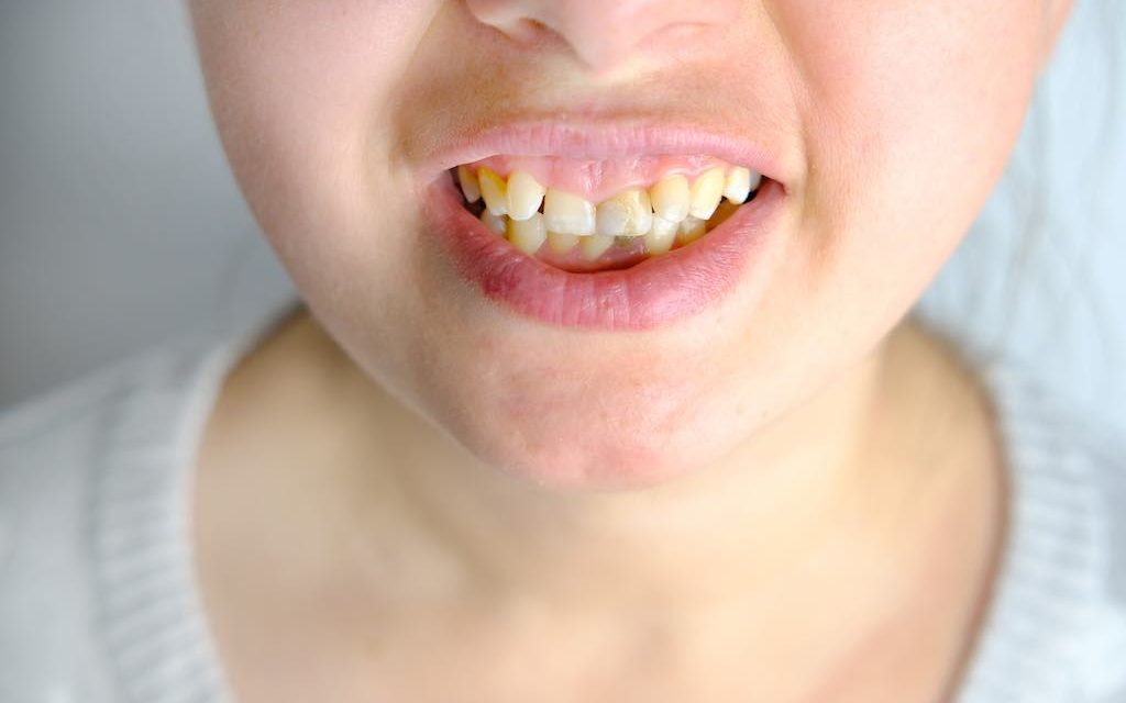 ¿Cómo corregir el apiñamiento dental?