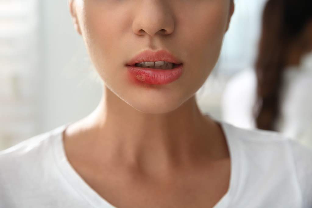 Rodeo Memorándum Enfriarse Por qué salen calenturas labiales? | Miriam Cantero
