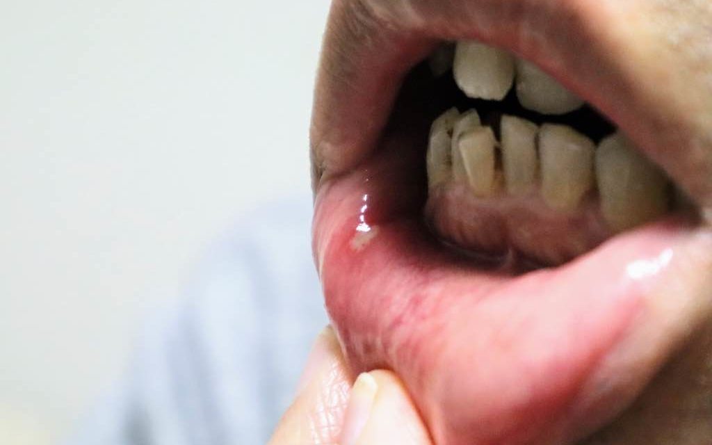 ¿Qué es la mucositis oral?