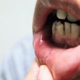 mucositis oral